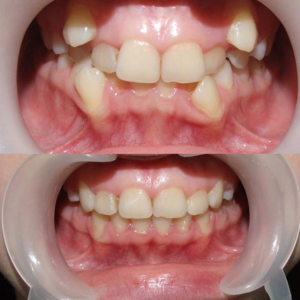 lecenoe-ortodontiya-do-i-posle-2.jpg