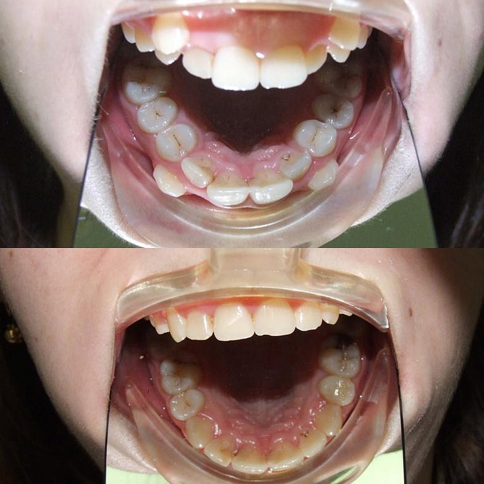 lecenoe-ortodontiya-do-i-posle-3.jpg